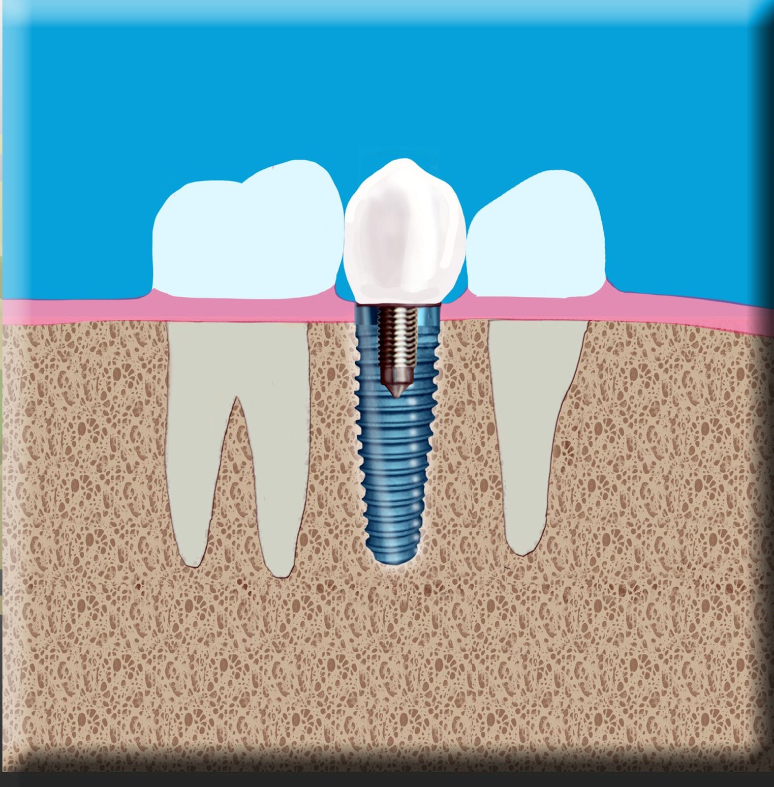Are there different types of dental implants?