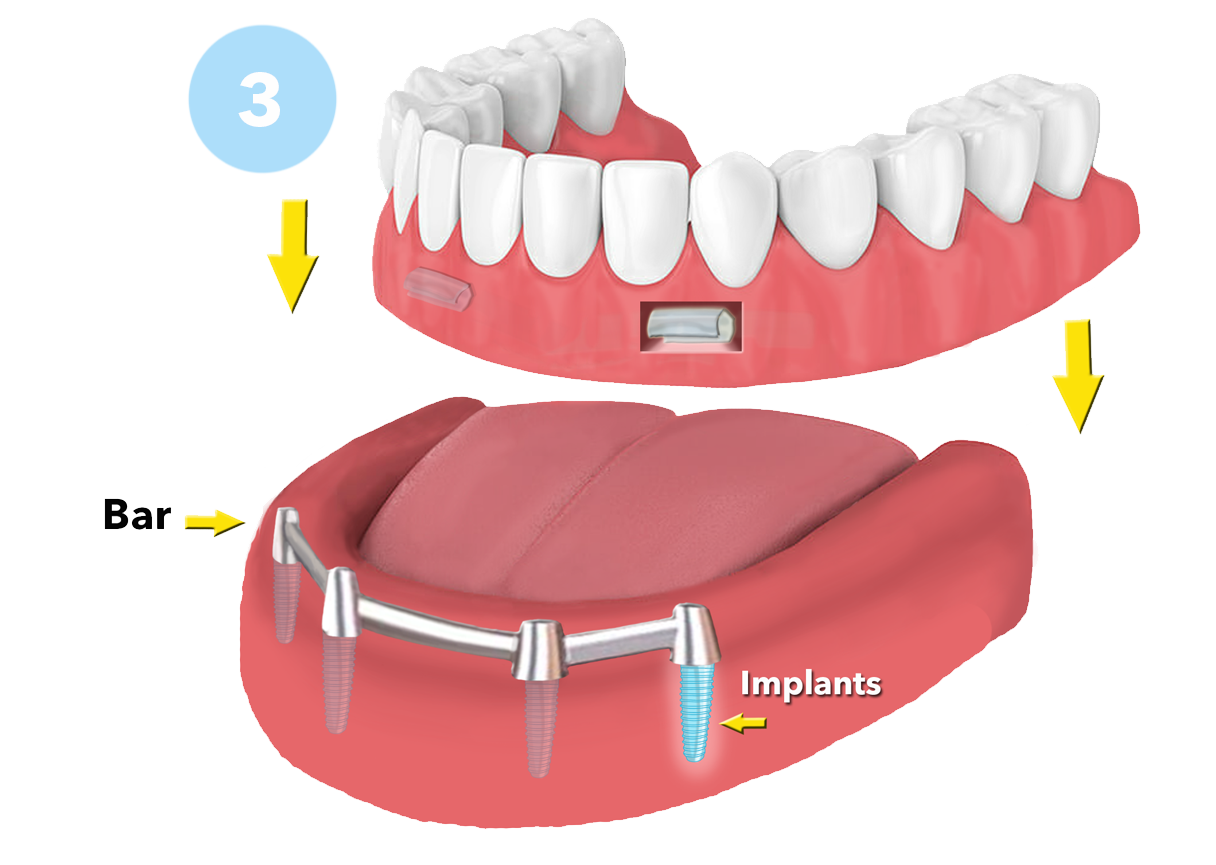 Dental Implants: Exploring Your Options for Replacing missing teeth