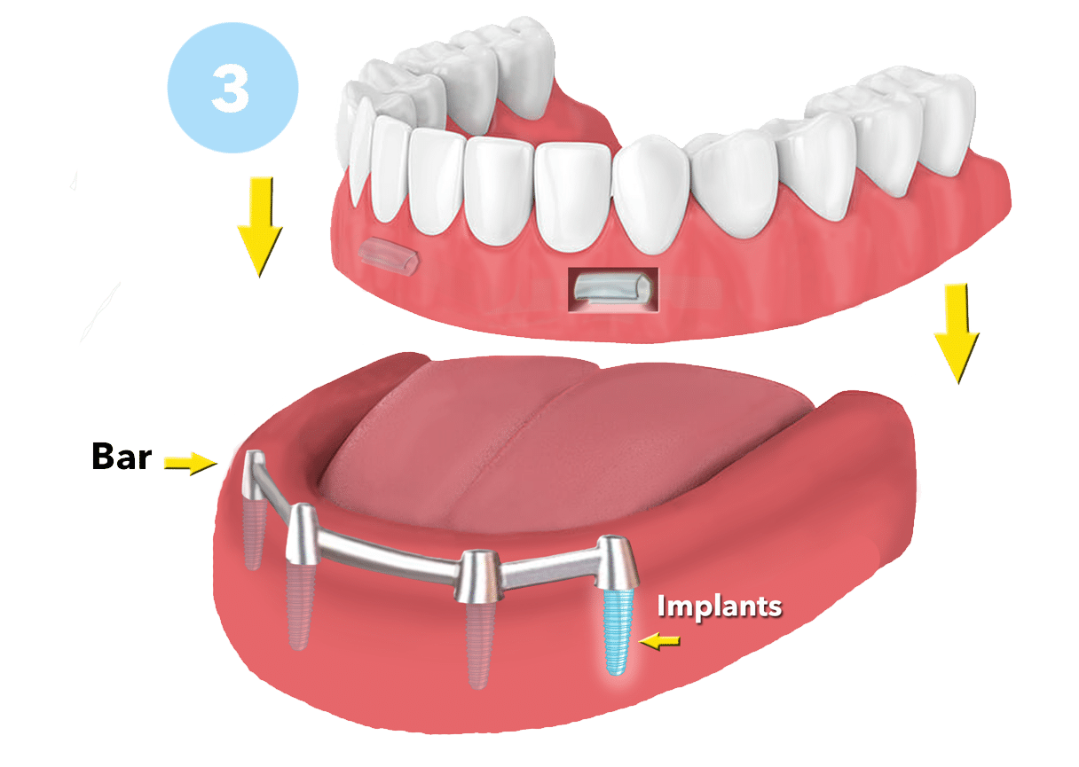 Dental Implants: Exploring Your Options for Replacing missing teeth