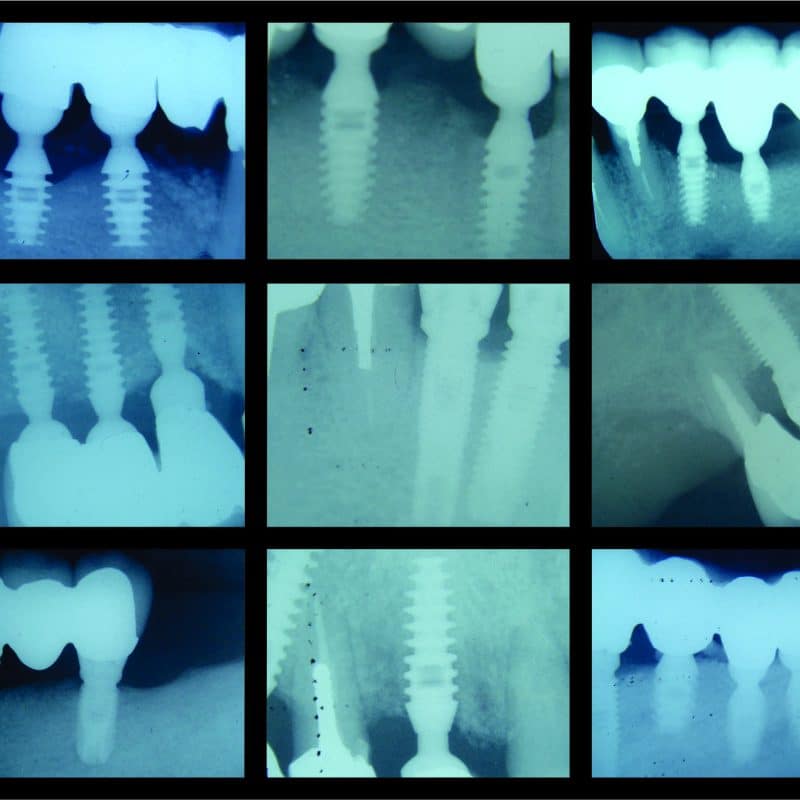 Multiple Teeth Replacement