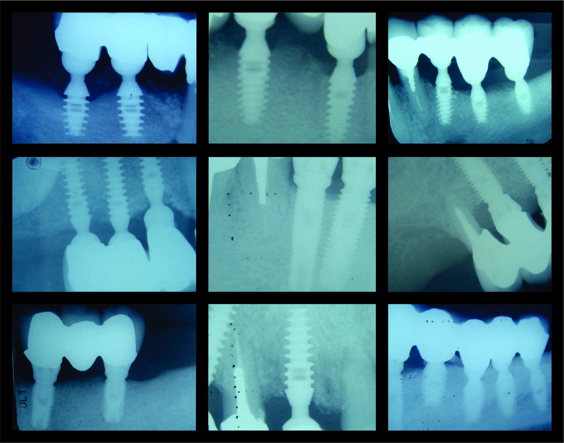 Are there different types of dental implants?