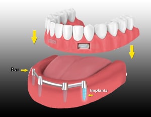 Overdenture