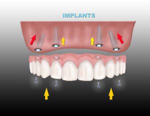All In 4, All On 4 Dental Implants